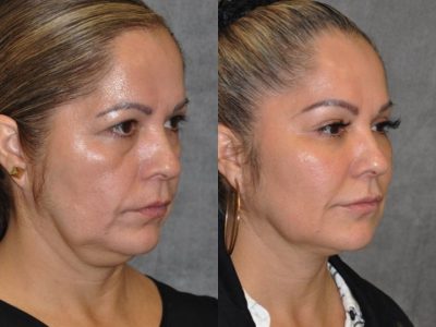 Liquid Facelift using Botox and Fillers - Right Side
