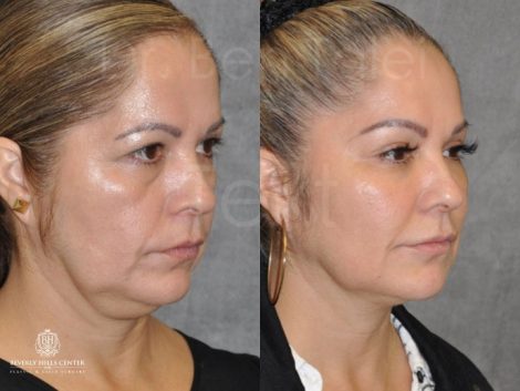 Liquid Facelift using Botox and Fillers - Right Side