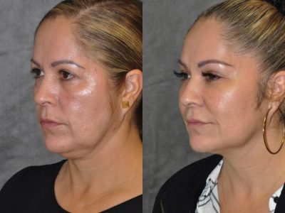 Liquid Facelift using Botox and Fillers - Left Side