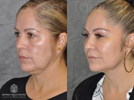 Liquid Facelift using Botox and Fillers - Left Side