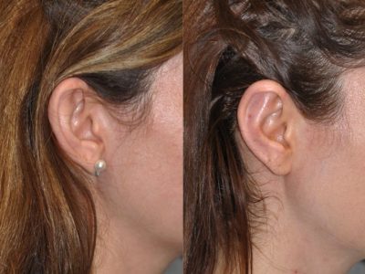 Otoplasty (Ear Pinning and Reshaping)