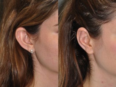 Otoplasty (Ear Pinning and Reshaping)