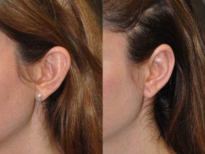 Otoplasty (Ear Pinning and Reshaping)