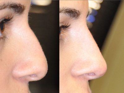 Non Surgical, Liquid Rhinoplasty / Nosejob