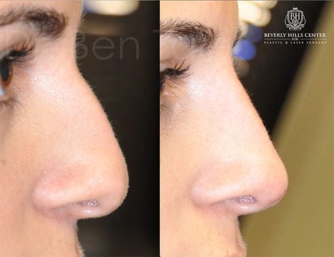 Beverly Hills Center Female Patient Before and After Non-surgical Liquid Rhinoplasty
