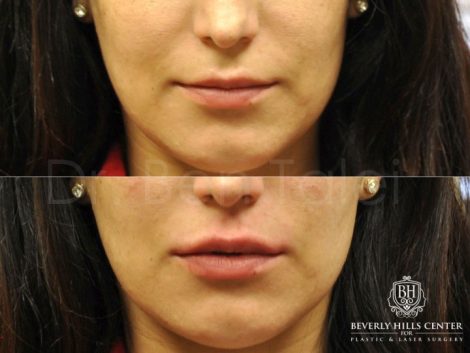 Beverly Hills Center Female Patient Before and After Lip Filler Procedure