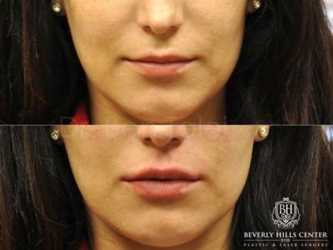 Beverly Hills Center Female Patient Before and After Lip Injection Procedure