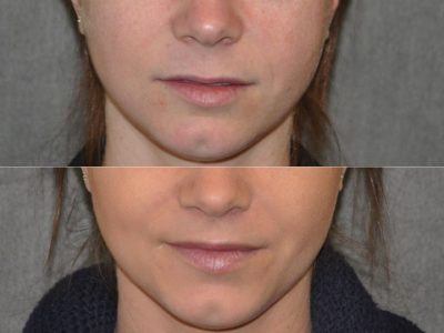 Modified Upper Lip Lift - Front