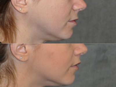 Modified Upper Lip Lift - Right Side