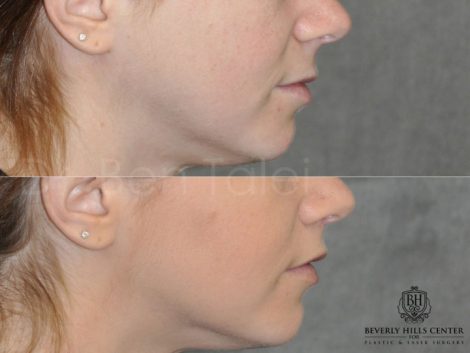 Modified Upper Lip Lift - Right Side