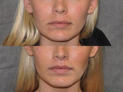 Modified Upper Lip Lift for balance - Front