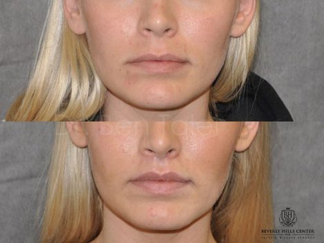 Modified Upper Lip Lift for balance - Front