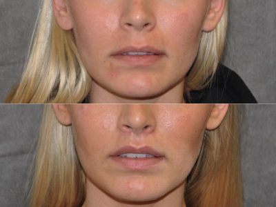 Modified Upper Lip Lift for balance - Front