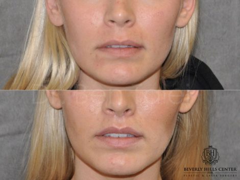 Modified Upper Lip Lift for balance - Front