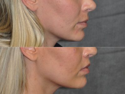 Modified Upper Lip Lift for balance - Right Side