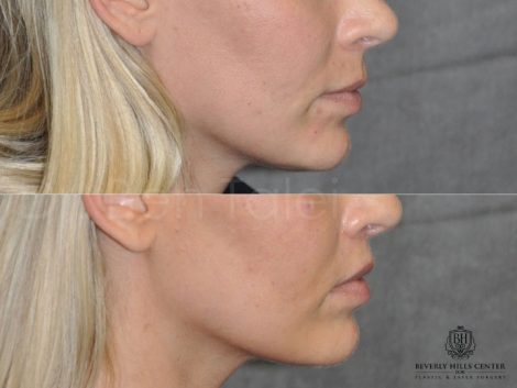 Modified Upper Lip Lift for balance - Right Side