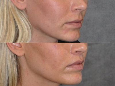 Modified Upper Lip Lift for balance - Right Side