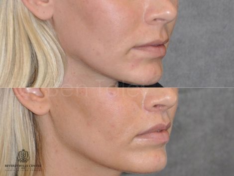 Modified Upper Lip Lift for balance - Right Side