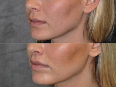 Modified Upper Lip Lift for balance - Left Side