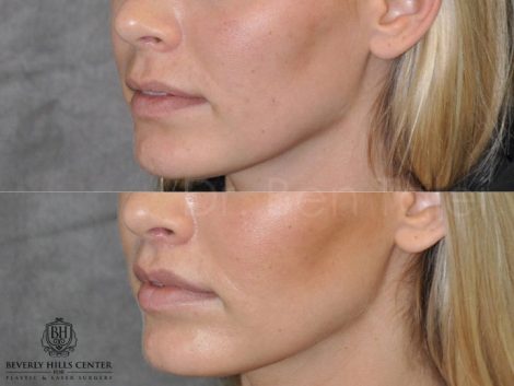 Modified Upper Lip Lift for balance - Left Side