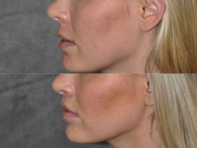 Modified Upper Lip Lift for balance - Left Side
