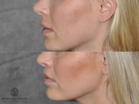 Modified Upper Lip Lift for balance - Left Side