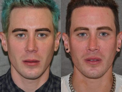 Modified Upper Lip Lift for Men – Front