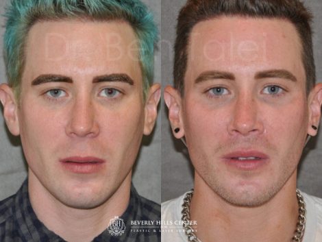 Modified Upper Lip Lift for Men – Front