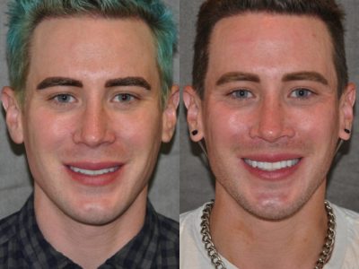 Modified Upper Lip Lift for Men – Front