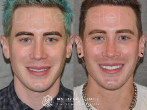 Modified Upper Lip Lift for Men – Front
