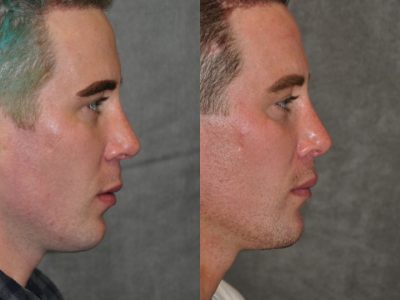 Modified Upper Lip Lift for Men – Right Side