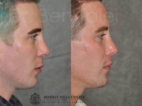 Modified Upper Lip Lift for Men – Rigt Side