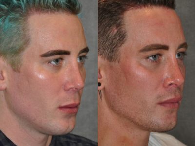 Modified Upper Lip Lift for Men – Right Side