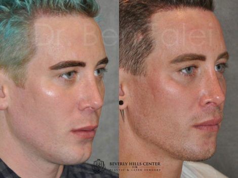 Modified Upper Lip Lift for Men – Rigt Side