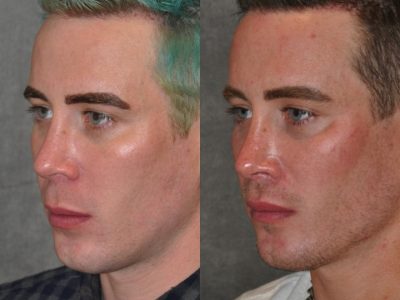 Modified Upper Lip Lift for Men – Left Side