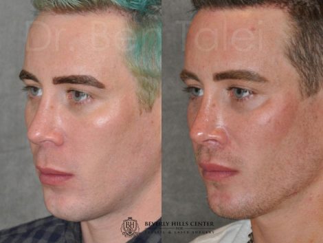 Modified Upper Lip Lift for Men – Left Side
