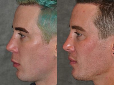 Modified Upper Lip Lift for Men – Left Side