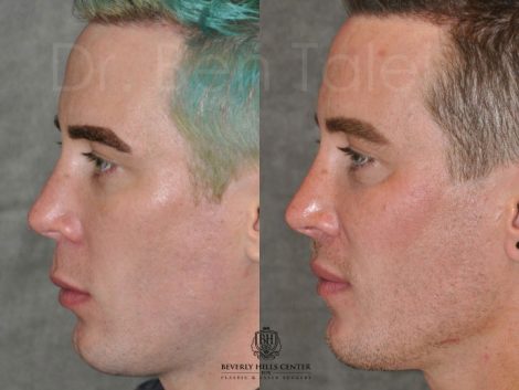 Modified Upper Lip Lift for Men – Left Side