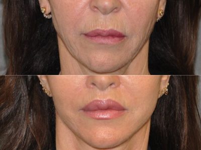 Modified Upper Lip Lift - Front
