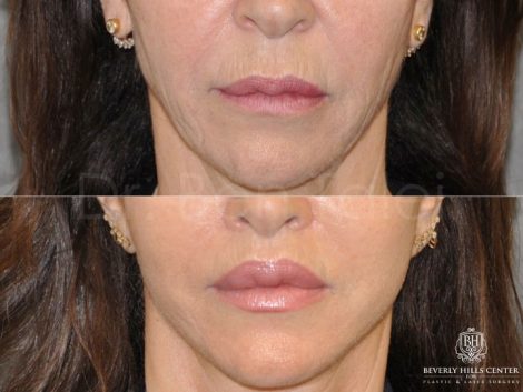Modified Upper Lip Lift - Front