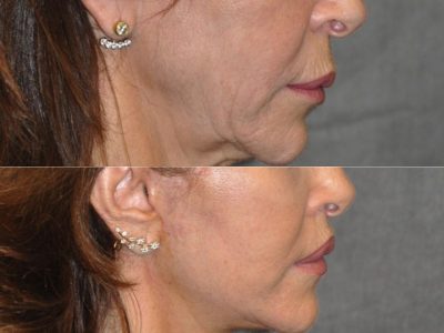 Modified Upper Lip Lift - Right Side
