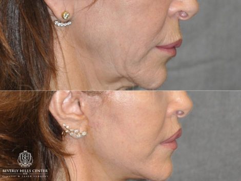 Modified Upper Lip Lift - Right Side
