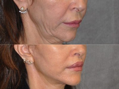 Modified Upper Lip Lift - Right Side