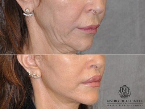 Modified Upper Lip Lift - Right Side