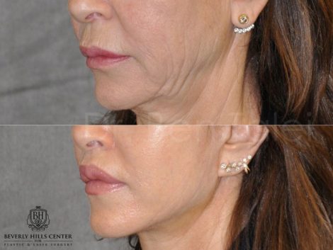 Modified Upper Lip Lift - Left Side