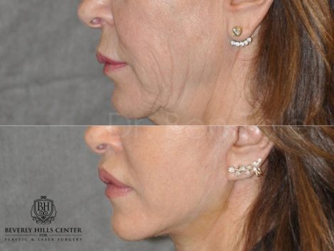 Modified Upper Lip Lift - Left Side