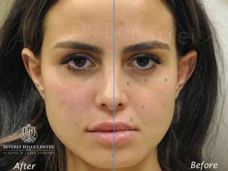 Beverly Hills Center Female Patient Before and After Cheek and Lip Filler Procedure