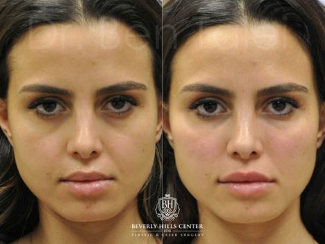 Beverly Hills Center Female Patient Before and After Cheek and Lip Filler Procedure