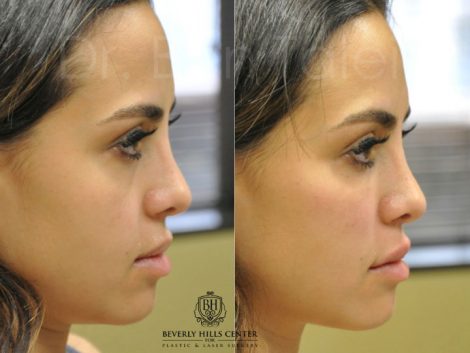 Beverly Hills Center Female Patient Before and After Cheek and Lip Filler Procedure