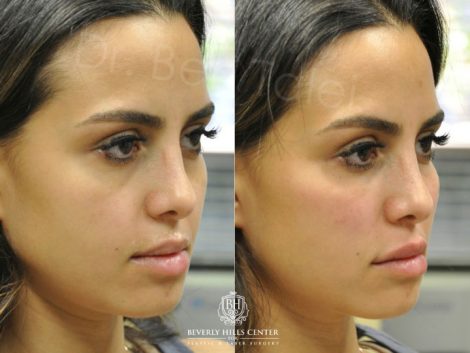 Beverly Hills Center Female Patient Before and After Cheek and Lip Filler Procedure